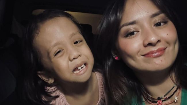 5 Potret Terbaru Ziona Anak Joanna Alexandra yang Mengidap Penyakit Langka